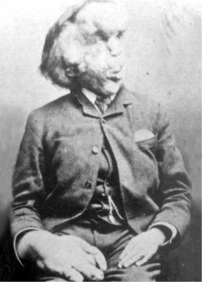 Joseph Merrick